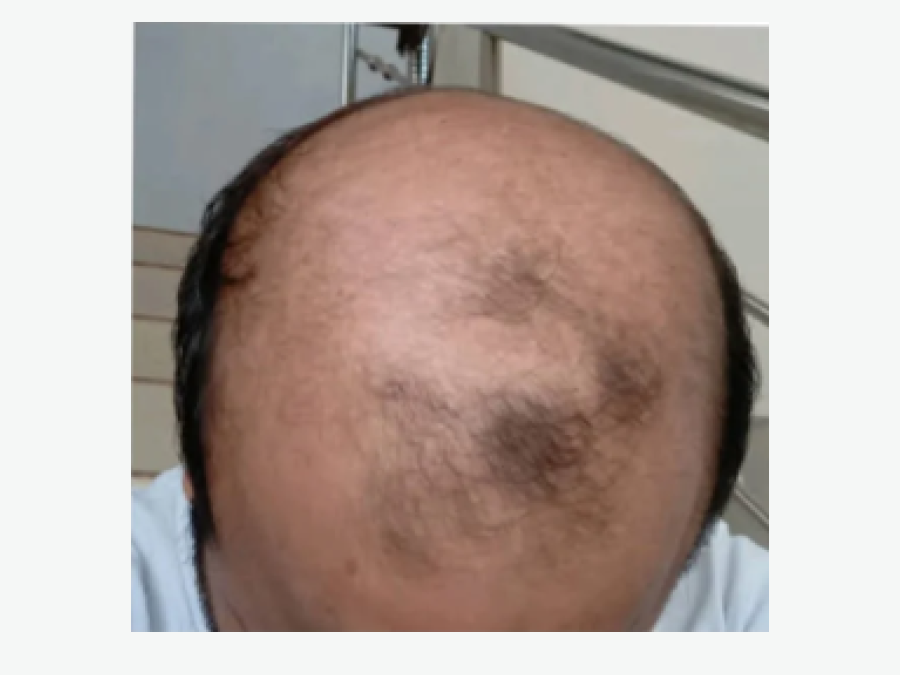 Before: Hair transplant