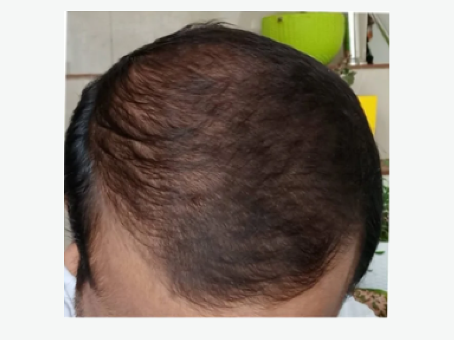 After: Hair transplant